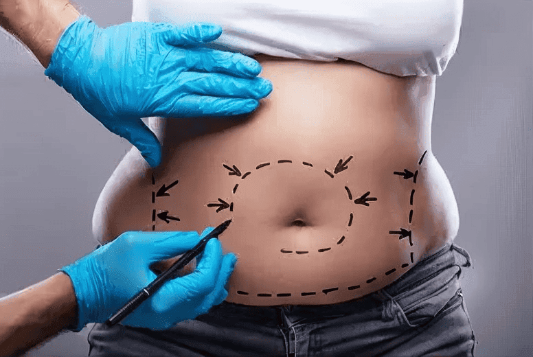 Abdominoplastia-clinicarealize